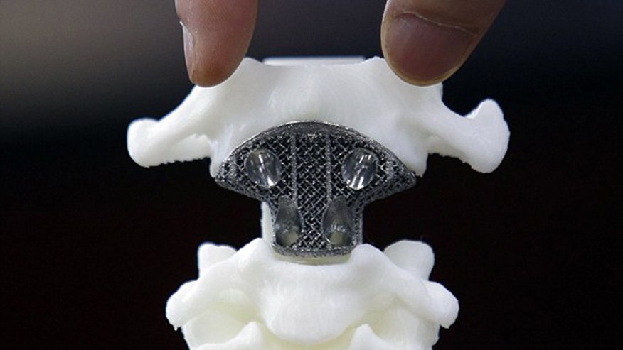 http://www.foxnews.com/health/2014/08/28/first-ever-3d-printed-vertebra-implanted-in-12-year-old-cancer-patients-spine/